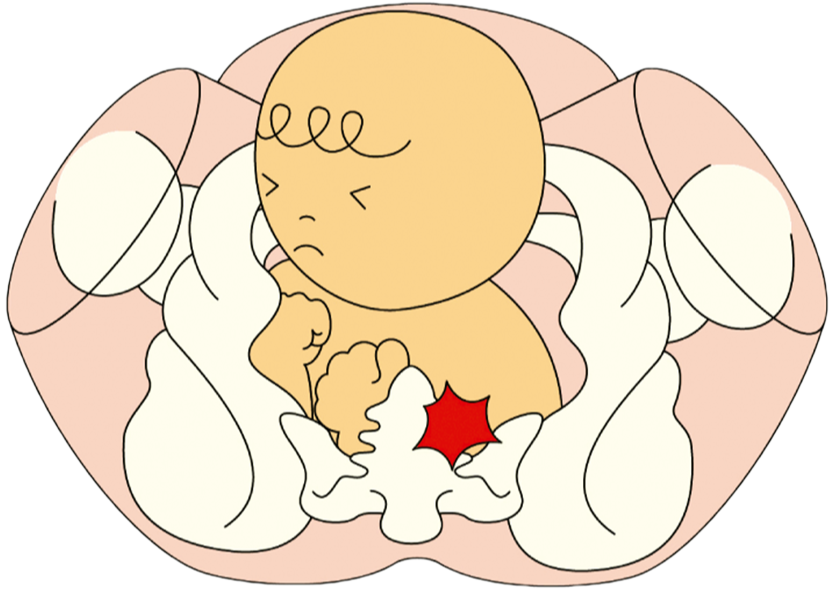 お母さんの骨盤のゆがみ