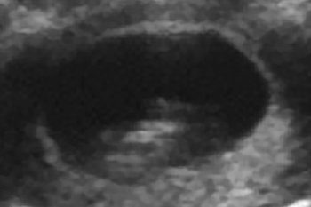 子宮を横方向に撮影　10週6日