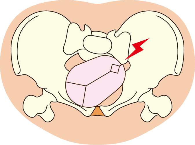 赤ちゃんの頭がひっかかる