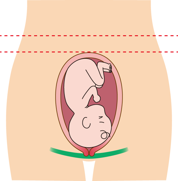 押しつぶされて短い子宮頸管