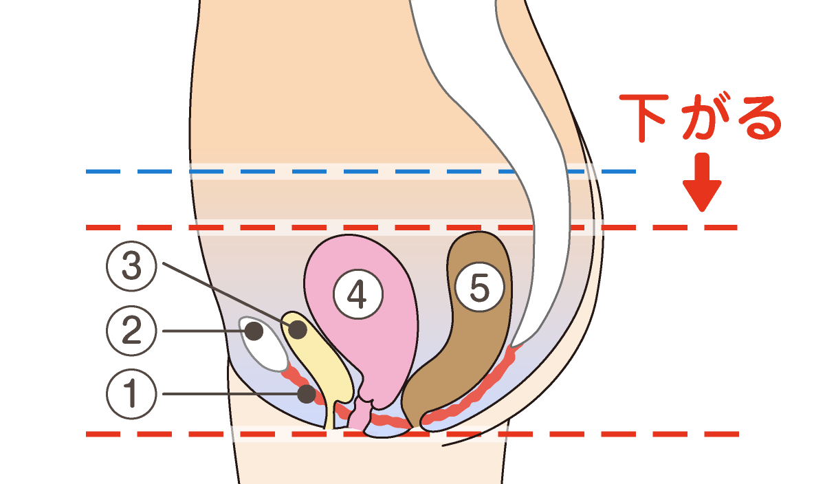 ゆるんだ骨盤底筋群